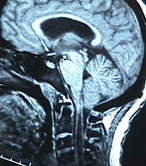 Chiari_Overview_Fig2.jpg